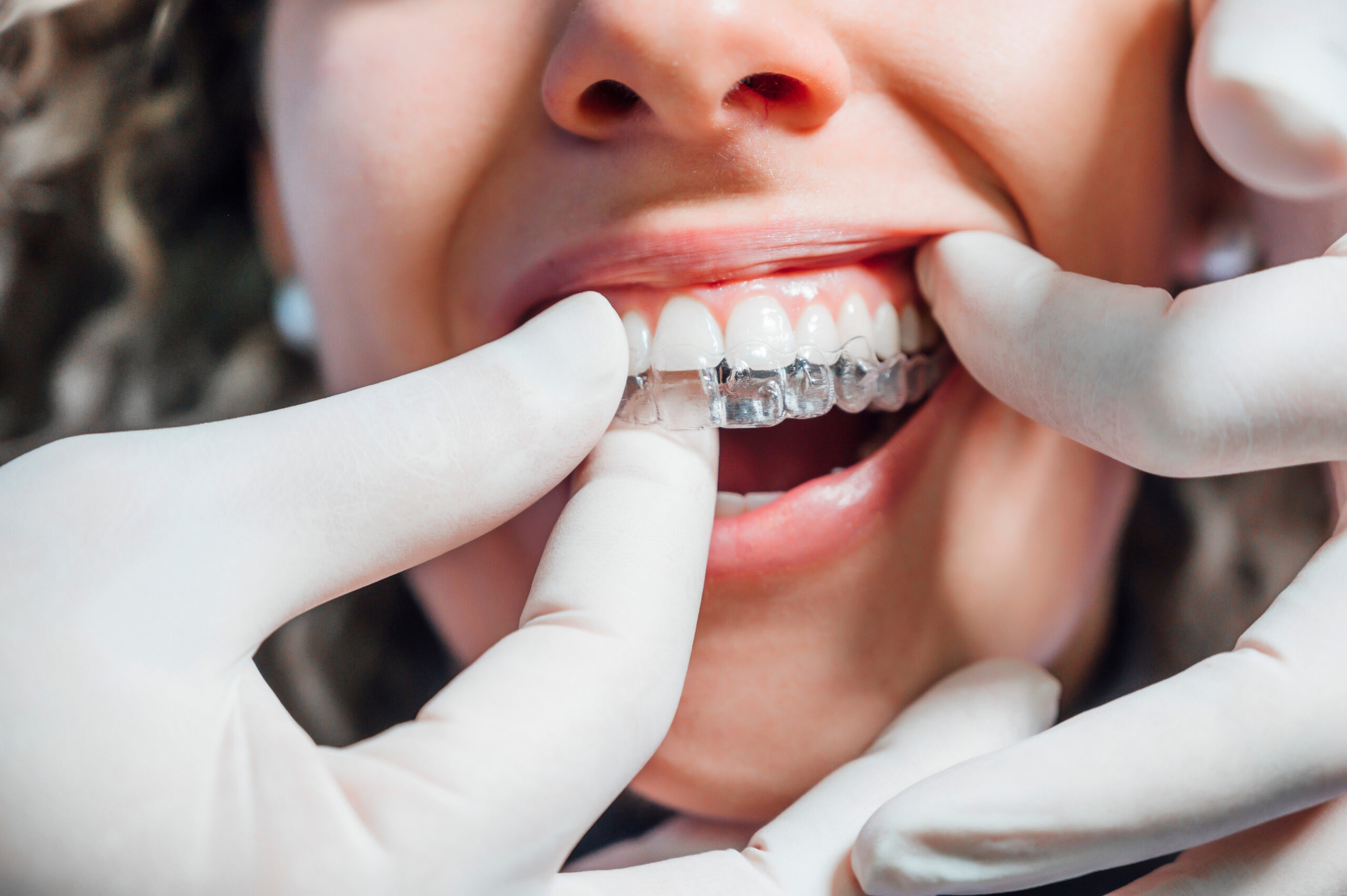 Doctor,Putting,A,Clear,Dental,Aligner,To,The,Patient,Woman